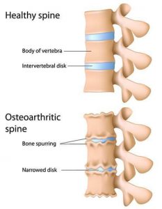 healthy spine vs osteoarthritic spine