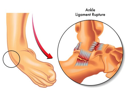 ankle-sprain-1