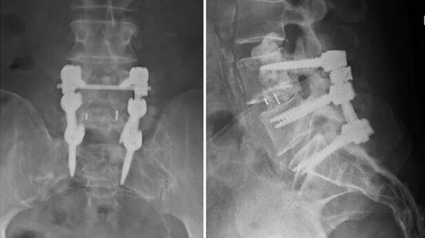 spinal surgery